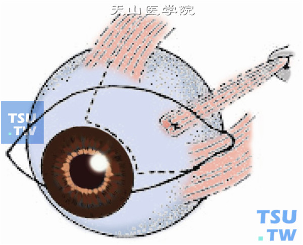 采用6-0可吸收线做肌腱1/3宽度的套环缝合，缝线前2mm处断离上斜肌肌腱，将上斜肌肌腱的前端固定于内直肌止端上、后3mm的巩膜，后端缝合于相应巩膜壁
