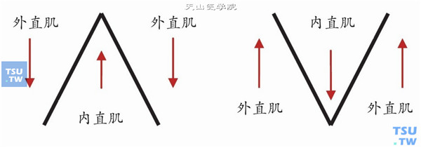 采用双眼对称性手术改变水平直肌附着点的位置矫正A-V综合征。其中，内直肌应向AV的尖端方向移位，外直肌则向AV的基底方向移位