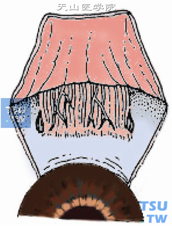 在需手术肌肉周围做一平行于角膜缘、长约1cm的结膜切口或采取角膜缘梯形结膜切口