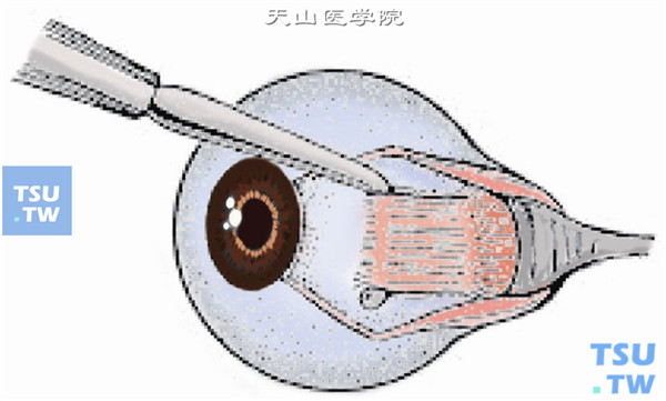 分离直肌两侧的Tenon囊并暴露巩膜面，用斜视钩牵引直肌、钝性分离肌肉周围的节制韧带