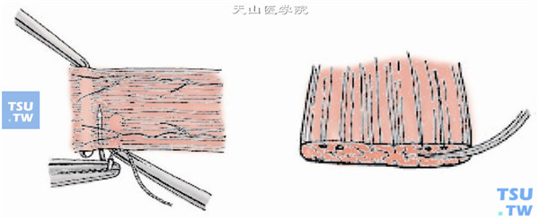 在肌肉附着点后1～1.5mm处，采用6-0可吸收线做肌腱1/3宽度的套环缝合