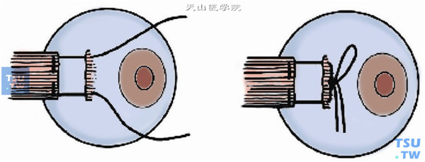 将肌腱断端上、下缘的套环线缝合于原附着处，并穿过切口处球筋膜及结膜，根据术前设计前后移动直肌至合适位置后将缝线打一活结。8-0尼龙线或5-0丝线连续或间断缝合结膜切口