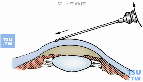 角膜、结膜异物剔除术