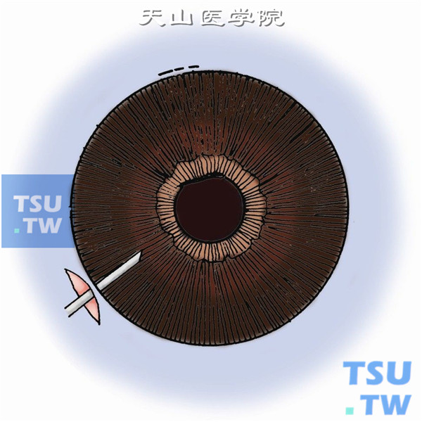 眼球前部异物摘除术