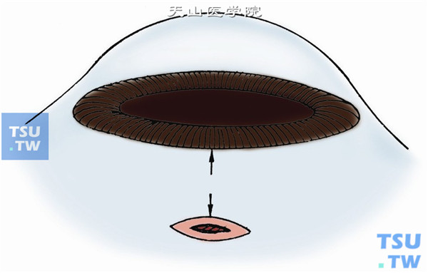 在异物所在方位，有晶状体眼据角巩膜缘4mm，层间切开巩膜，切口与角膜缘平行，长度根据异物大小以能顺利取出异物为准。一般为2～4mm