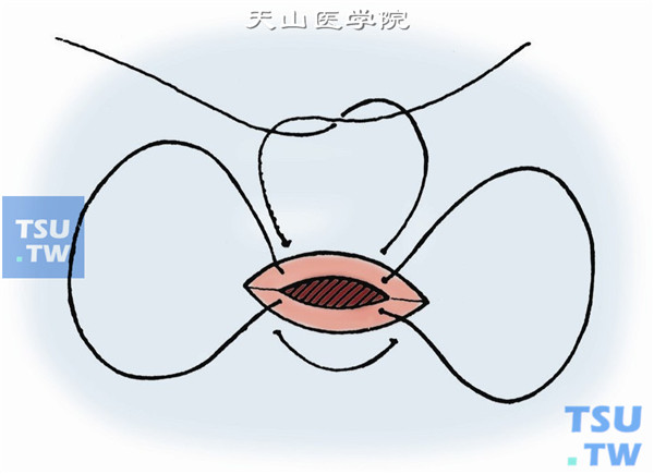 用8-0吸收缝线预作巩膜切口蹄系缝线