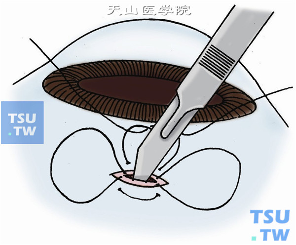 拉开蹄系线线圈，进一步切穿全层巩膜并暴露色素膜