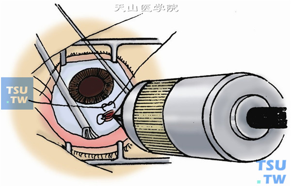 手持电磁铁头置于巩膜切口内