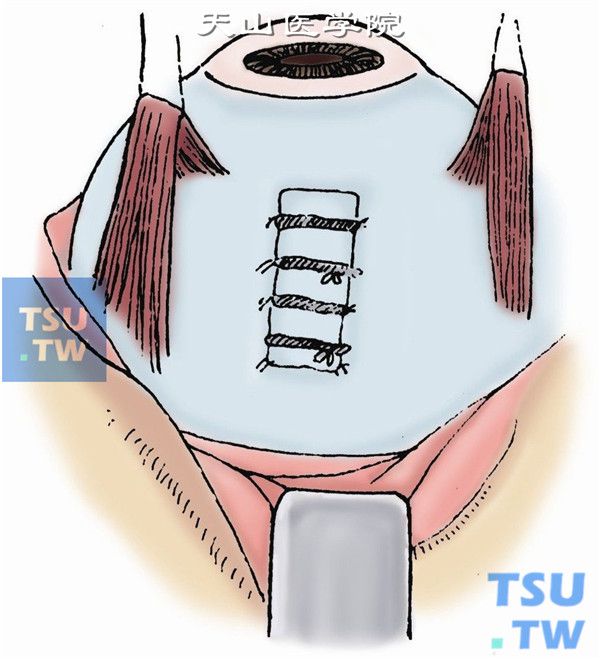 巩膜切口处用5-0尼龙线与硅海绵作一局部外加压