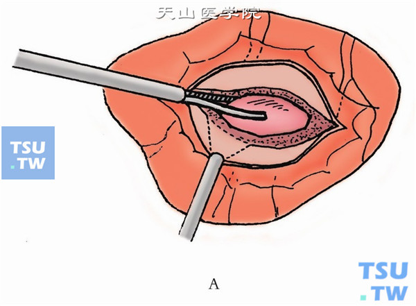 扩大巩膜切口，插入异物镊，夹住异物取出