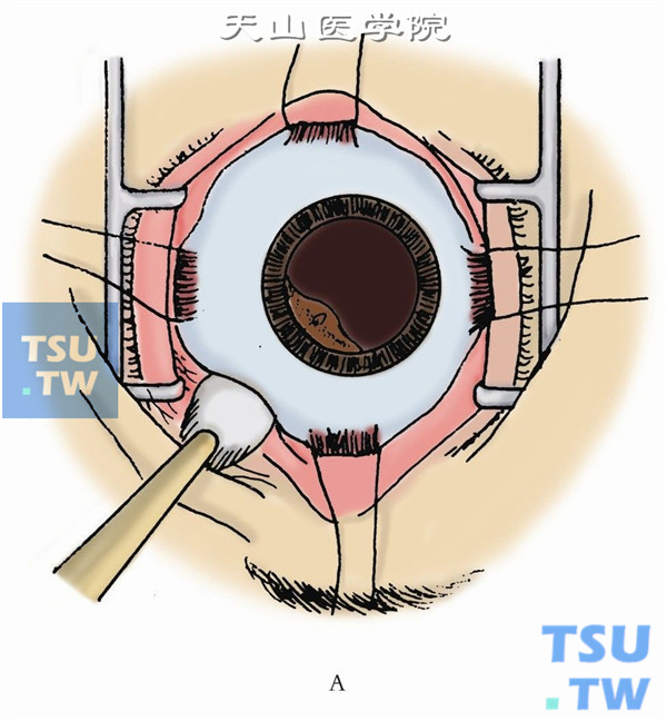 如异物位于周边部，用棉签或斜视钩将异物所在处的周边巩膜向内顶压