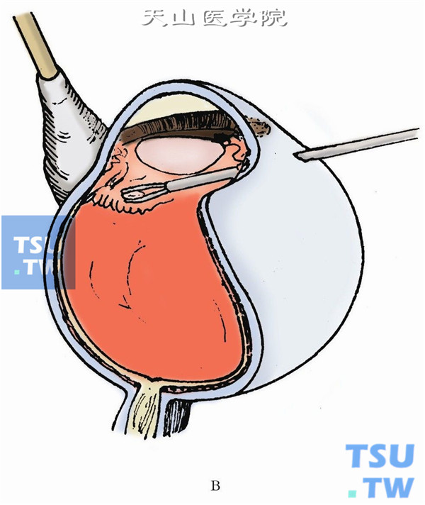 显微镜同轴光源照明下与后部异物一样，切开分离异物周围包膜使其游离后取出