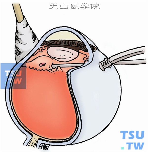 缝合扩大的巩膜切口，再次插入导光纤维与切割头，切除残存的玻璃体、组织碎屑及血液