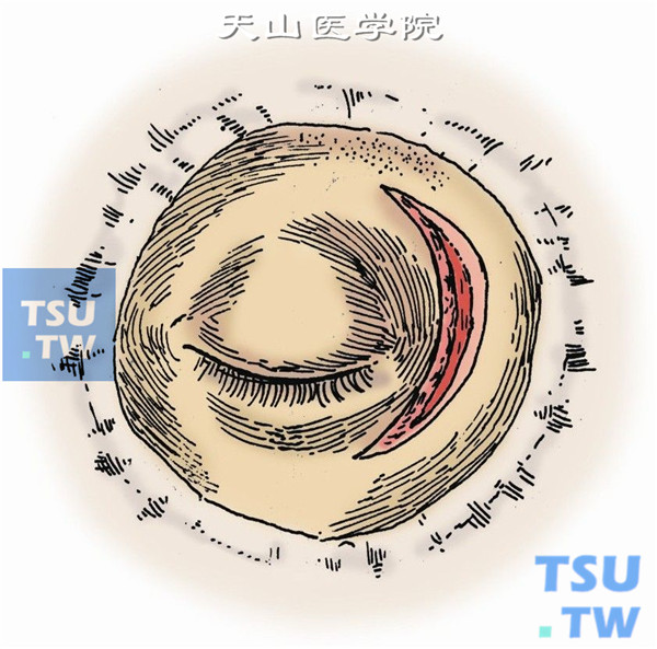 在异物所处象限沿眶缘切开皮肤及皮下组织，血管钳或电灼止血