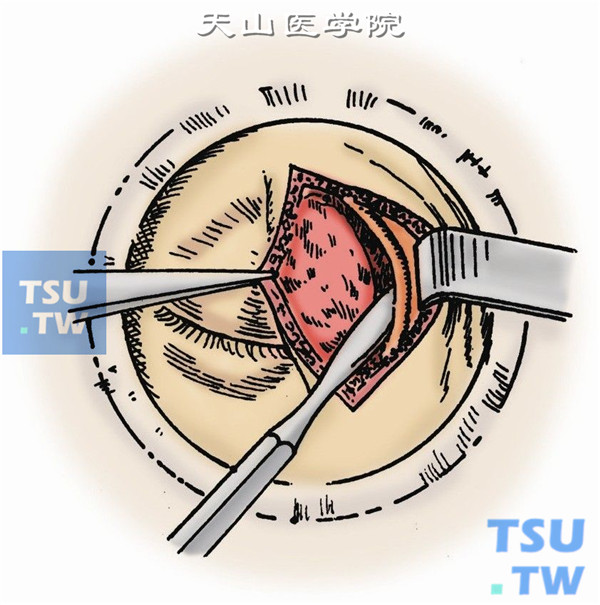 沿眶缘切开骨膜，骨膜起子将骨膜与眶骨分离，进入骨间隙