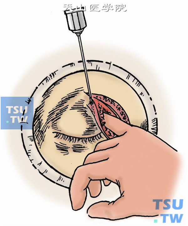 对植物性异物已产生瘘管的病例，将一金属探针插入瘘道内直达瘘管底部，用食指在骨膜下间隙通过骨膜扪摸探针位置，然后沿探针方向纵行切开眶骨膜，分开眶内组织及脂肪直到瘘管处