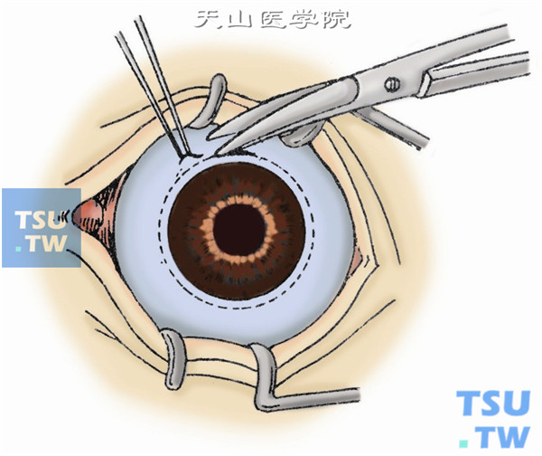 切开球结膜。需沿角膜缘环形剪开结膜