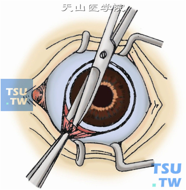 分离球结膜至4条直肌止端
