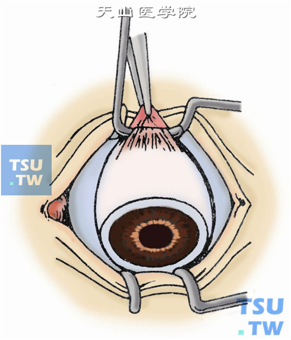 暴露眼外肌，在相邻直肌之间用剪刀分离筋膜与巩膜