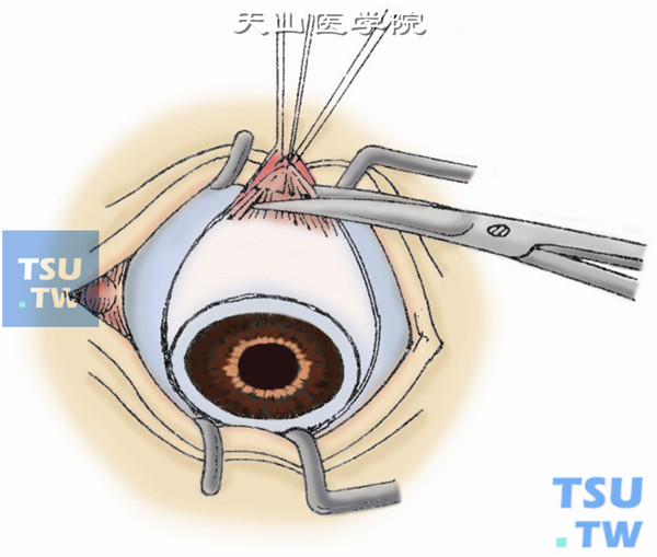 剪断6条眼外肌。用斜视钩勾住上直肌，在肌止端后3mm预置一根缝线，提起上直肌并在肌止端处剪断之。用同样方法剪断内、外及下直肌