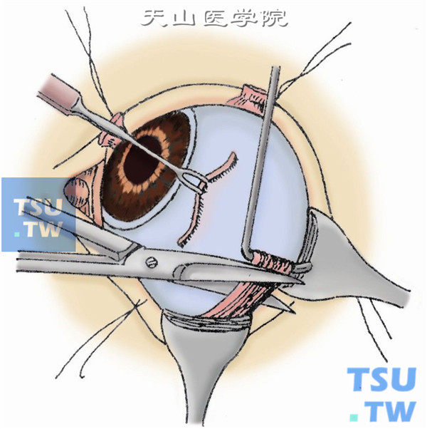 剪断下斜肌。向鼻侧牵引眼球，同时向外拉开颞侧球结膜，用斜视钩紧贴巩膜面向颞下方近肌止处勾住下斜肌，并用剪刀剪断