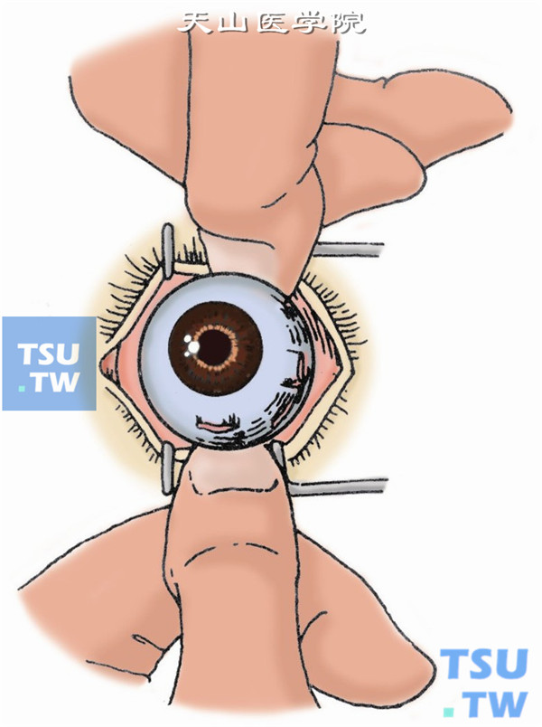 将眼球半脱臼。在剪断视神经前，用双手指尖向后压迫上下睑，使眼球置于上下睑缘外呈半脱位状态