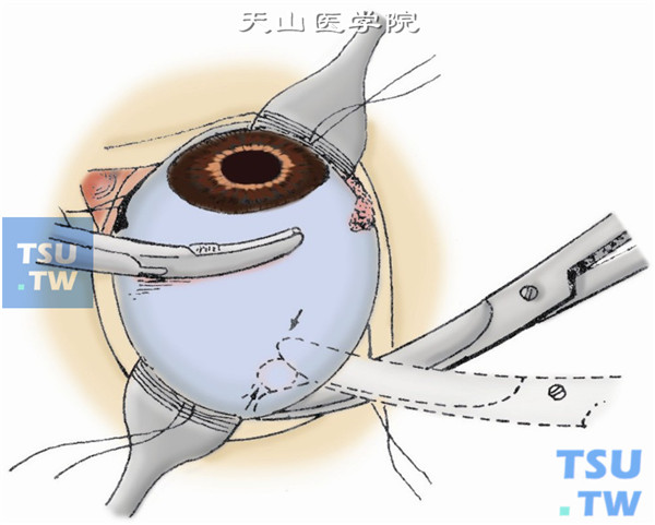 探索视神经。自眼球鼻侧靠紧眼球下斜肌伸入一弯血管钳到球后，夹住视神经约2～3min（以减少出血）后，用弯血管钳夹住内直肌肌腱残端，将眼球向正上方牵拉，持闭合的视神经剪，视神经剪一般自鼻侧伸入眼球后方，探索到如绳索样的视神经