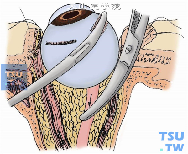 剪断视神经。轻轻张开视神经剪，尽量向后贴眶尖处将视神经剪断