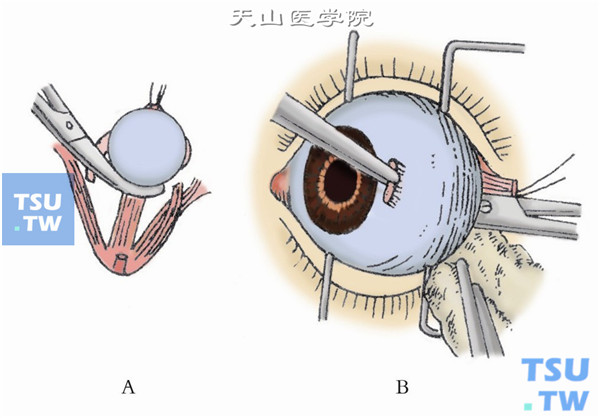 逼出眼球。确定视神经剪断后，用剪刀将眼球逼出眶外，再剪断残余牵连组织。取出眼球后，迅速用湿热纱布块填塞眶内，压迫止血