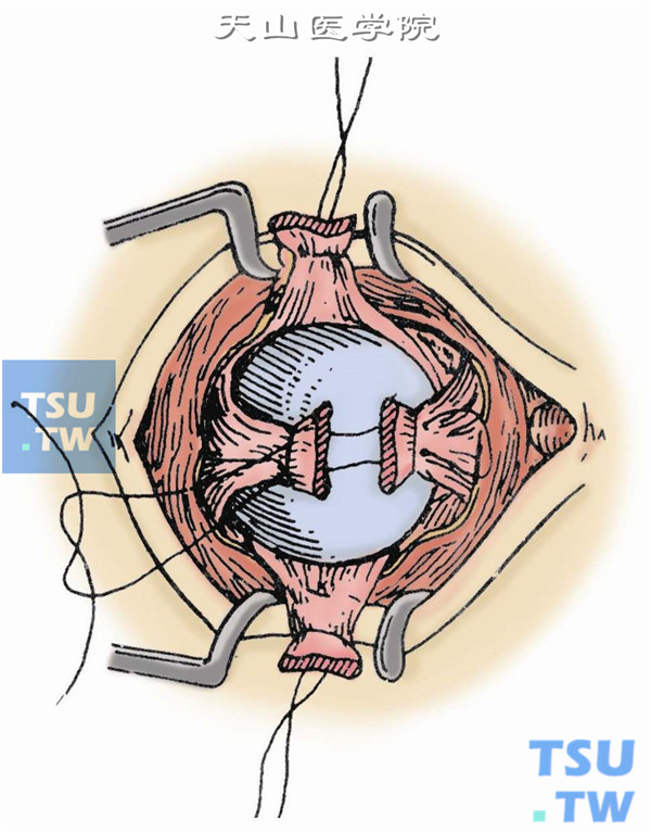 缝合眼外肌。提起4条直肌的预置留线，如在眶内放置球形填充物，可将其置于眶深部4条直肌的中间，再分别以上、下直肌及内、外直肌各为一组，用5-0丝线作褥式缝合，形成“十”字形的肌肉交叉