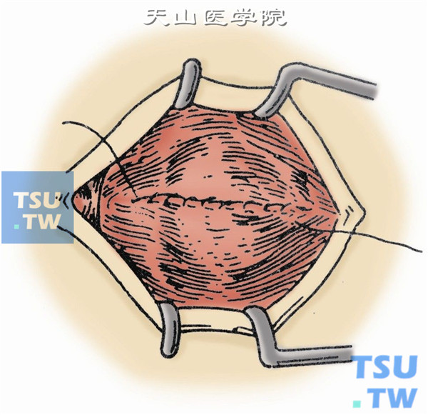 球结膜创缘用5-0丝线做水平的连续缝合，两线端引出内外眦外。结膜囊内填入凡士林纱条或眼模，使上下穹窿部有适当的支撑。单眼眼垫，绷带作压迫包扎