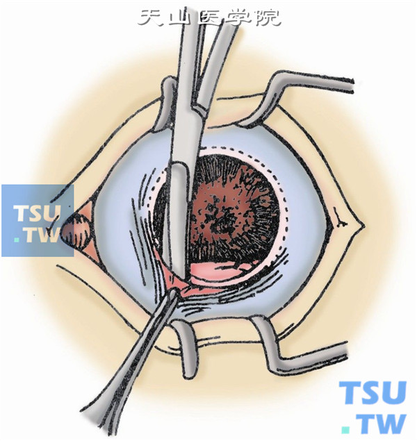 沿角膜缘环形切开球结膜并向后分离眼球筋膜囊