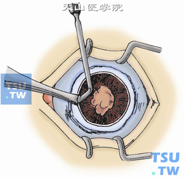 分离葡萄膜。用睫状体分离器伸入虹膜根部将睫状体及脉络膜做全周分离