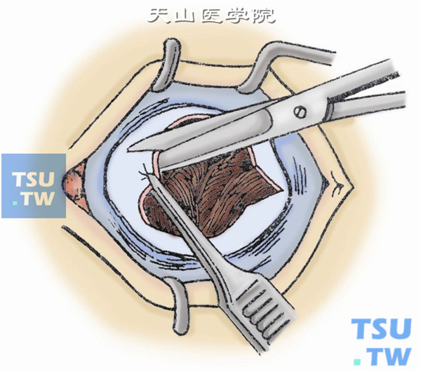 切除部分巩膜。在3点和9点处各剪除一个小三角形巩膜组织