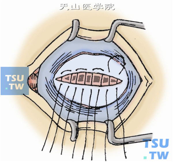 缝合切口。用5-0丝线经板层巩膜做间断缝合。结膜囊内填入凡士林小条，单眼眼垫压迫绷带