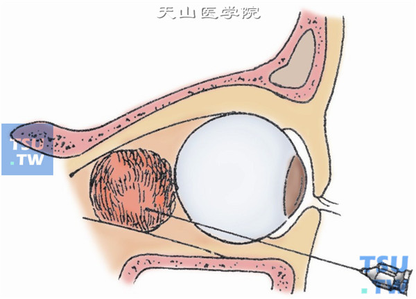 眼眶脓肿切开引流术