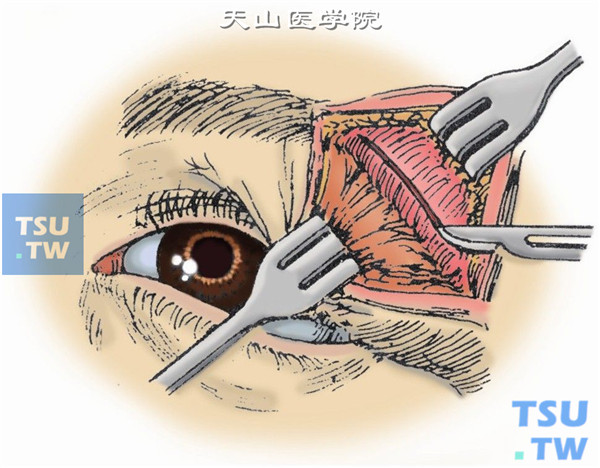 切开眶缘骨膜，再顺着眶壁以骨膜分离器向后充分分离眶内骨膜与骨壁