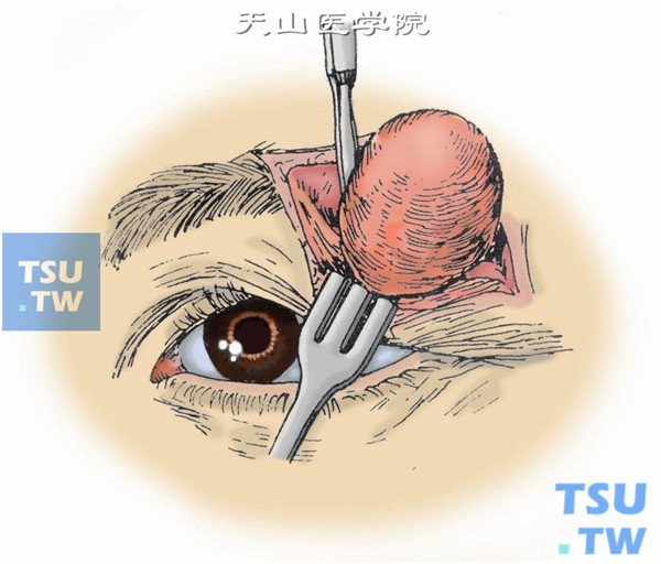 确定肿瘤位置。用食指或小指伸入眶内触探肿瘤位置，然后确定适当部位，垂直切开骨膜，用剥离器分离取出肿瘤，如肿瘤为囊肿性质破裂，则将其囊剔出