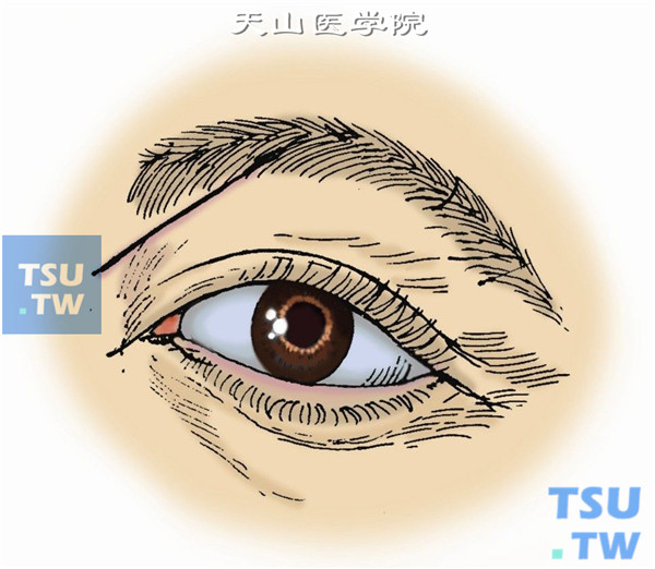 沿上内侧眶缘做皮肤弧形切口，外至眶中线，内至鼻根内眦韧带附着处，分离皮下各层组织达眶缘骨膜，切勿损伤眶上神经和滑车