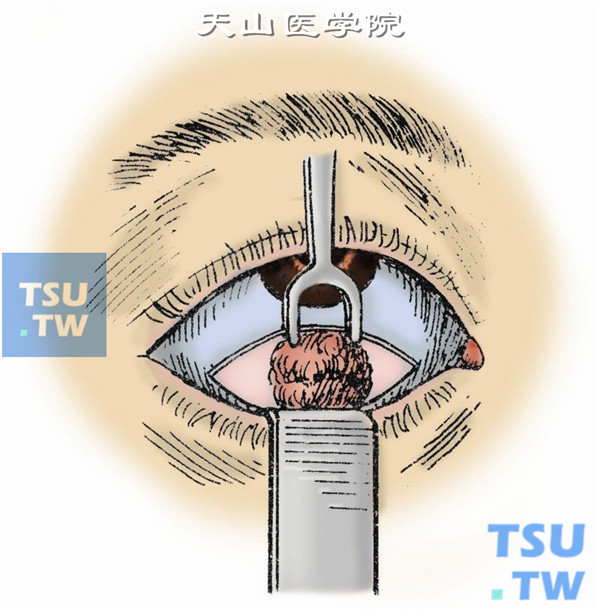 沿着肿瘤表面分离直至取出肿瘤