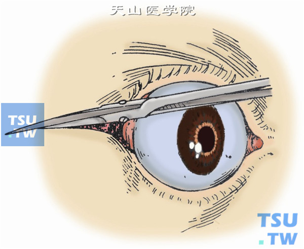 剪开外眦，顺皮纹水平延长切口至眶缘外2.5～3cm