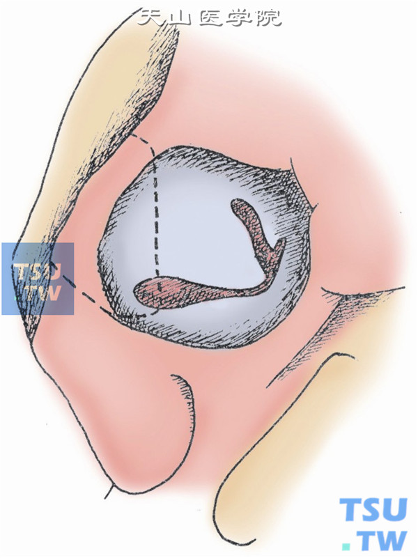 眶外壁切开。如肿瘤小而被暴露，则可不切开外壁