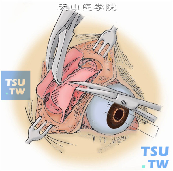 眶内容暴露。用骨钳把骨瓣扳向外侧，露出骨膜，再由前向后垂直剪开眶外侧壁骨膜。用食指入眶内探查肿瘤部位与周围组织的关系，后将外直肌向一侧牵开，暴露肿瘤
