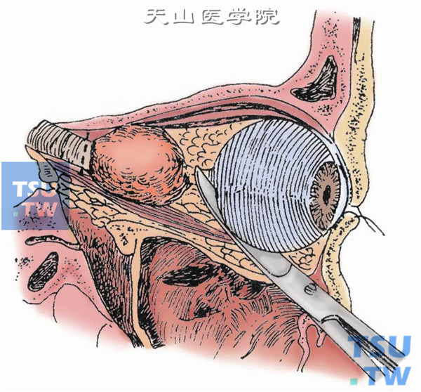 视神经胶质瘤摘除见图11