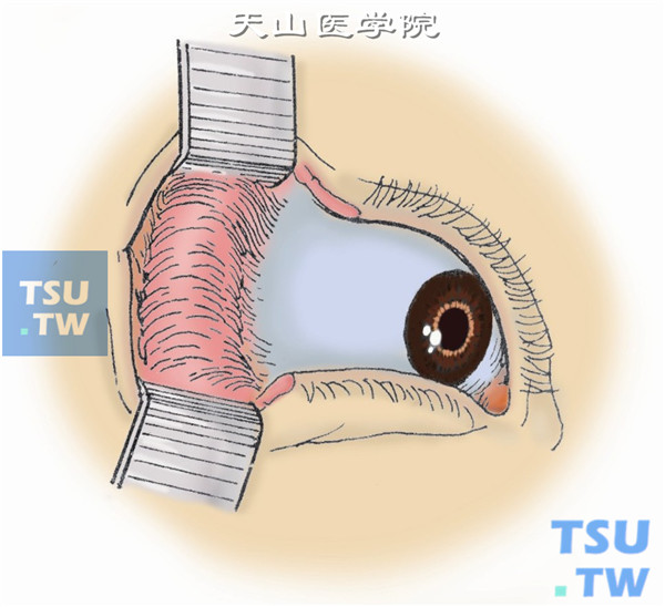 剪断外眦韧带上、下支，分离切口皮下组织，露出眶外缘骨膜