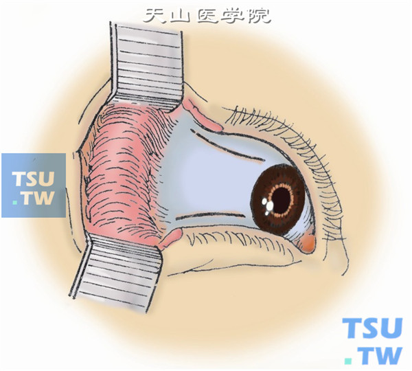 沿上、下穹窿剪开结膜，长约12mm