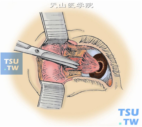 分离结膜至外直肌止端