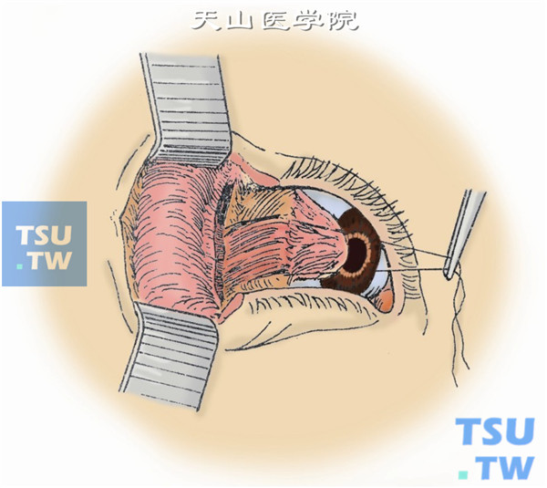 沿外侧眶缘切开眶隔及外侧节制韧带。做外直肌牵引线把眼球引向鼻侧