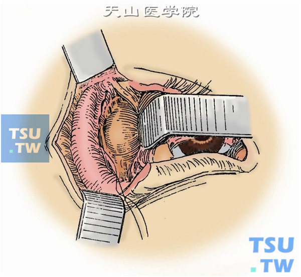 用深部拉钩伸入眶内，把眶内组织拉向鼻侧，显露眶内肿瘤。钝性分离，摘除肿瘤同外侧开眶法