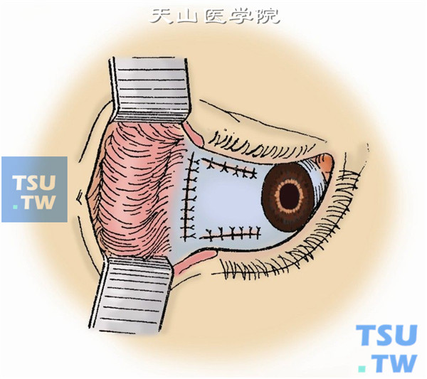 依次分层缝合眶内切开的组织